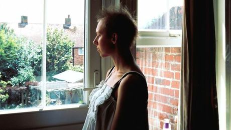 Carly Clarke rụng hết tóc sau các đợt hóa trị kéo dài. Ảnh: Carly Clarke