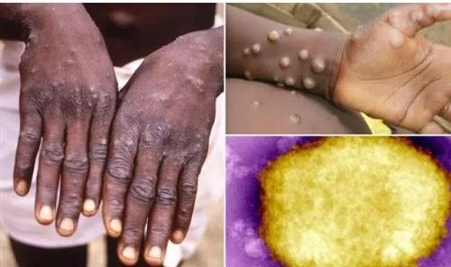 Các triệu chứng của virus đậu mùa khỉ được hiển thị trên bàn tay của một bệnh nhân