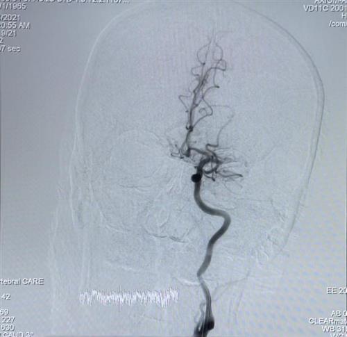 Bệnh nhân bị tắc hoàn toàn động mạch não giữa phía bên trái đoạn gốc. Ảnh: BVCC